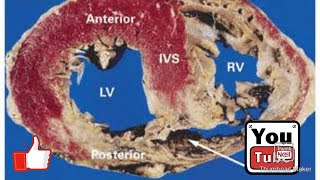 Post Infarct Ventricular Septal Rupture [upl. by Ecirp]