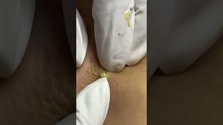 Big Cystic Acne Blackheads Extraction Blackheads amp Milia Whiteheads Removal Pimple Popping shorts [upl. by Delores]