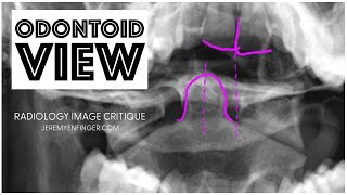 Radiology Image Critique Odontoid View [upl. by Laohcin]