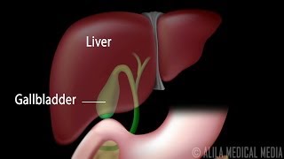 Gallstones and Surgical Removal of Gallbladder Cholecystectomy Animation [upl. by Aymik336]