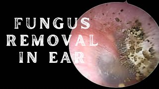 EAR AURAL TOILETING FOR OTOMYCOSIS [upl. by Cyprian544]