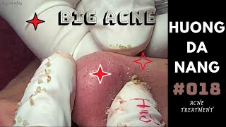 018  Super BIG acne all over the face  Mụn siêu to khắp mặt  Hương Đà Nẵng  akne Behandlung [upl. by Nimad]