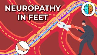 Numbness or Tingling in the Feet or Toes Mortons Neuroma Treatment [upl. by Tanny]