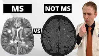 MS MRI Lesions VS quotBenignquot White Matter Lesions Explained by Neurologist [upl. by Ettesel]