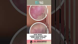 How Many Laser Sessions do we Need for Port Wine Stain Removal Laser treatment of PortWine Stains [upl. by Lynnet461]