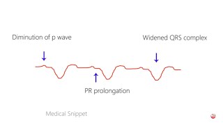 Hyperkalemia  ECG [upl. by Nashbar]