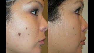 How To Use Castor Oil For Skin Moles [upl. by Fagan454]