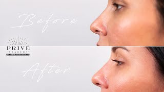 Plasma Fibroblast  Prive Academy  Nose Contouring Technique [upl. by Airetnuhs823]