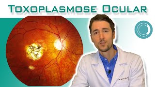 Toxoplasmose ocular  tratamento [upl. by Hesler]