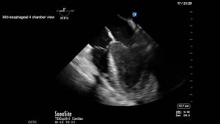 Transesophageal Echocardiography Management of ECMO [upl. by Camilia]