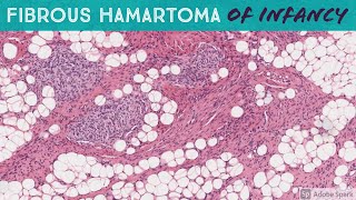 Fibrous Hamartoma of Infancy [upl. by Eremaj604]