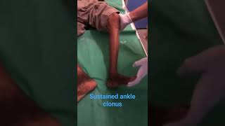 sustained ankle clonus  DR TMAM [upl. by Aretta]