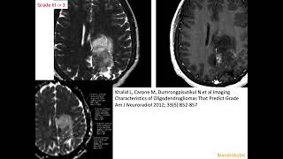 63 Oligodendroglioma 1p19q codeleted IDHmutant corticalsubcortical mass oligoastrocytoma [upl. by Nortad]