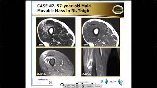 MRI of the Muscles Lectures  Part 2 [upl. by Avon]