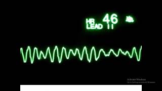 How to read ECG Episode 1 by Dr Ahmed Elshatory MD Clinical Toxicology [upl. by Nymsaj]