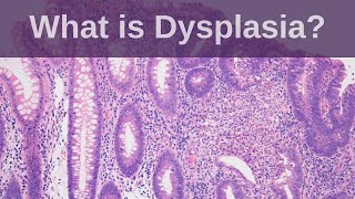 What is Dysplasia  Pathology mini tutorial [upl. by Holladay]