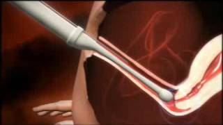 3D animation of how IVF works [upl. by Page]