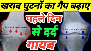 घर बैठे घुटनों का गैप बढ़ाने का सबसे आसान तरीकाKnee Osteoarthritis Treatment [upl. by Jorie537]