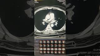 CTPA  Angiogram Pulmonary embolism medicalimaging angiography ct scan [upl. by Stalk]