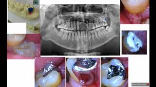 47 醫藥人 楊幽幽 智慧齒阻生引致前面牙齒蛀牙及牙周病 Editorinchief Online Journal of Dentistry amp Oral Health [upl. by Layap]