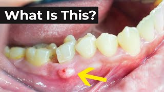 What is an Abscessed Tooth amp What To Do About It [upl. by Irmina]