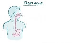 Superior Mesentric Artery Syndrome  Osmosis [upl. by Nirraj]