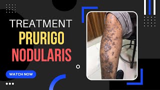 Prurigo Nodular Eczema Treatment ITCHY Skin bump एक्जिमा इलाज Dr Uttam Lenka [upl. by Assirual668]