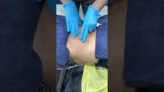 Fat Dissolving Injection to Belly [upl. by Gottuard]