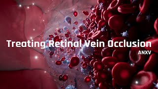 Treating Retinal Vein Occlusion RVO [upl. by Nirad]