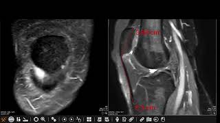 Patellar tendonlateral femoral condyle friction syndrome Hoffa fat pad impingement syndrome [upl. by Jeb]