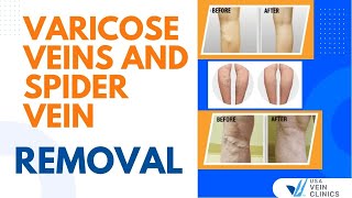 Varicose Veins and Spider Vein Removal  USA Vein Clinics [upl. by Brunhilde]