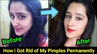 How to Remove Pimples Acne Pimple Marks completely  ThatGlamGirl [upl. by Emelen502]