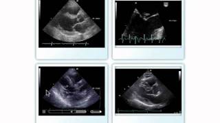 Native Valve Endocarditis [upl. by Ecitsuj]