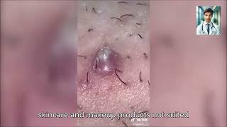 Ultimate Pimple Popping 2024 Powerful Acne Treatments [upl. by Ploss724]