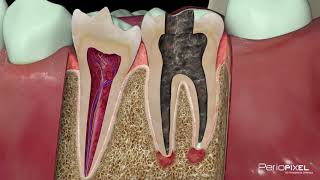 Vídeo 3D  Tratamiento de endodoncia en caries profundas [upl. by Mcnair]