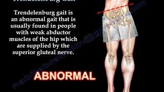 Trendelenburg Gait  Everything You Need To Know  Dr Nabil Ebraheim [upl. by Ennahgem]