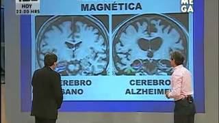 Cómo identificar si padeces Alzheimer [upl. by Naic]