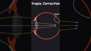 optics  hypermetropia and corrections physics scienceshorts scienceclass10 shortviral [upl. by Julia288]