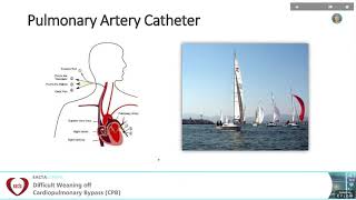 Haemodynamic and other Monitoring during weaning off CPB  Eric Benedet Lineburger Brasil [upl. by Eisyak677]