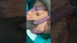 crohn disease  small bowel stricture small bowel resection anatomosis [upl. by Obie]