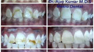 Teeth whitening Dental Bleaching  Dental fluorosis [upl. by Glynas]