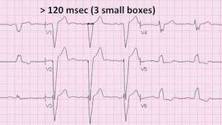 Left Bundle Branch Block [upl. by Keldon]