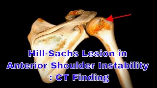 HillSachs Lesion in anterior shoulder instability  CT Finding [upl. by Lonier]