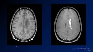 Neuroradiology board review 3 case 2 [upl. by Airottiv]