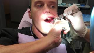 Taking Out My Own Wisdom Tooth [upl. by Cavan]