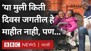 Conjoined twins Inspiring Story  ‘या मुली किती दिवस जगतील हे माहीत नाही पण [upl. by Colombi]