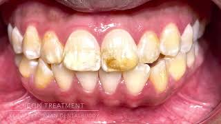 Icon treatment Fluorosis [upl. by Rovert]