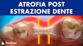 Atrofia postestrazione dente © [upl. by Neau]