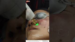 Achieve Clear Skin Now Port Wine Stain Removal with PDL Laser from Clear Skin Hair and Laser Centre [upl. by Christabelle]