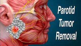 Parotid Mass Removal and Facial Nerve Considerations Parotidectomy [upl. by Eiddam334]